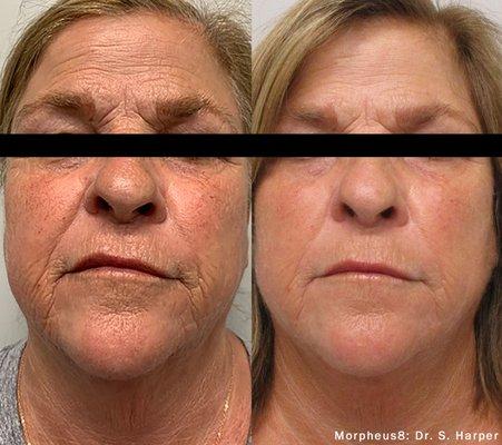 Before and After Face tx of Morpheus 8. Reduced her wrinkles and smoothed out her skin while tightening at the same time.