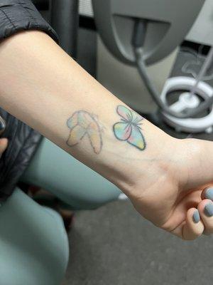 Rethink Your Ink Laser Tattoo Removal