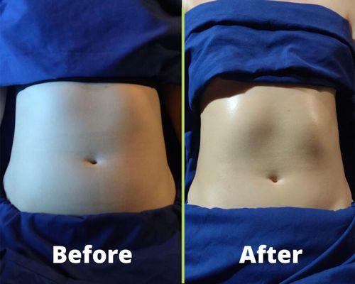 Results after one 50-min body contouring session. Notice the reduction in fluid and increased body definition.