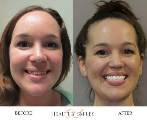 Kris's smile transformed with Invisalign clear braces!