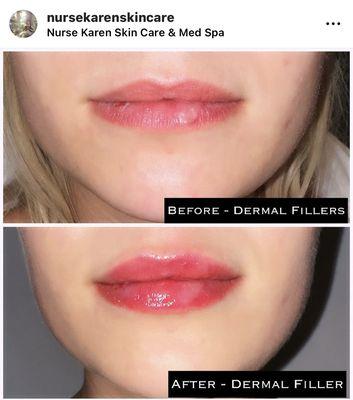 Beautiful lip filler! Lip treatments in Austin by a nurse injector, FNP. Always natural lips.