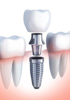 In order from bottom to top; implant, abutment and crown.