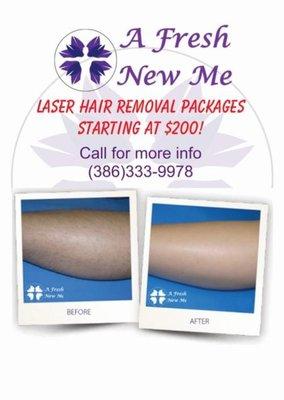 Best Laser Hair Removal Treatments