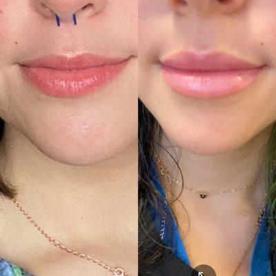 Before and afters of Juvederm lip fillers.