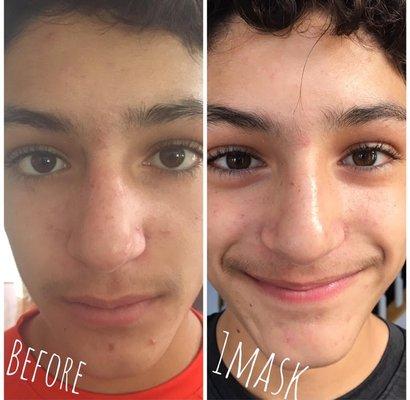 Look at the difference! Especially after only one session of my detoxifying charcoal mask! That's a happy teen.