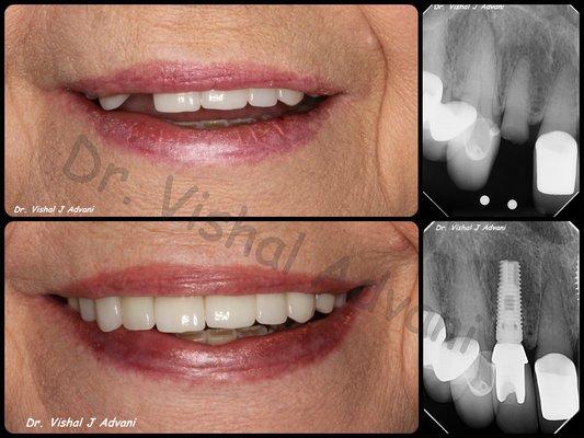 1-visit extraction and dental implant placed by Dr. Vishal Advani at Mint Smile Studio