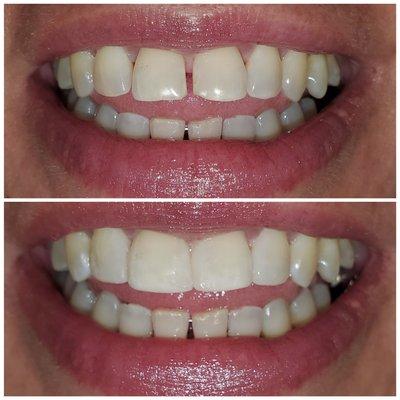 Composite restorations to fill the gaps! a more affordable option if you don't want veneers or crowns