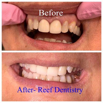 Cosmetic crown case completed by Dr. Kile Sherry