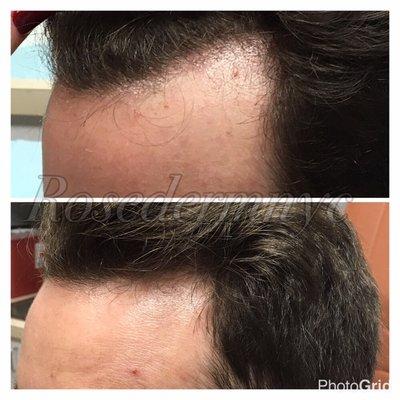 Before and after 2 treatments of PRP for hair loss.