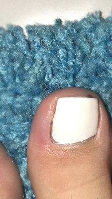 Infected toe