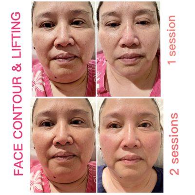 Face Contour & Lifting