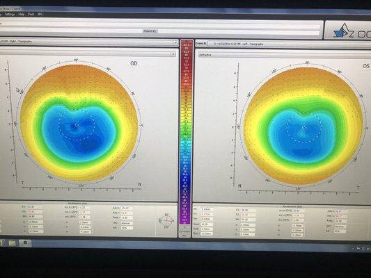 My cool corneal maps!