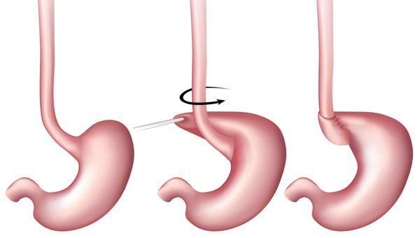 Laparoscopic Nissen Fundoplication