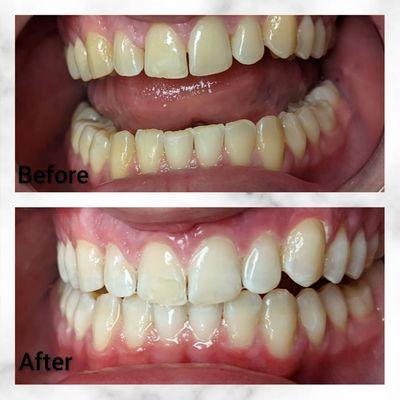 Cosmetic Teeth Whitening