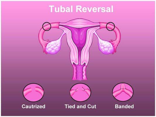 Tubal Reversal, "Untying the Tubes"