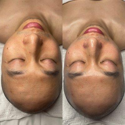 Microdermabrasion before and after