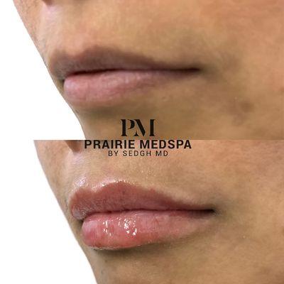 Lip enhancement at Prairie Medical Spa