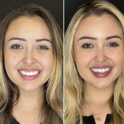 Smile Transformation by Dr. Trevelin Procedures done: -Crown lengthening  -Gingivoplasty surgery -RCT -Veneers 8 teeth -Whitening