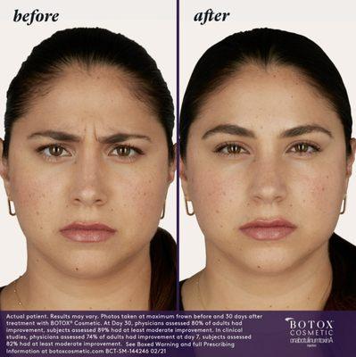 Botox-before&After