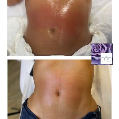 VelaShape III® is a non-invasive body contouring treatment for circumferential and cellulite reduction*.