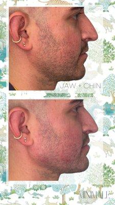 Jaw Filler