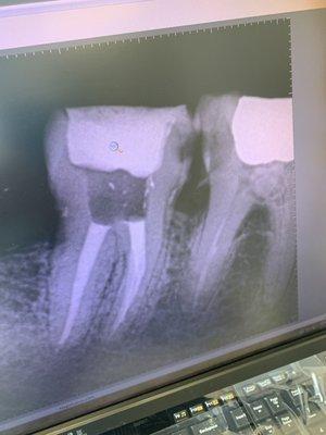 great root canal work by dr. aivaz