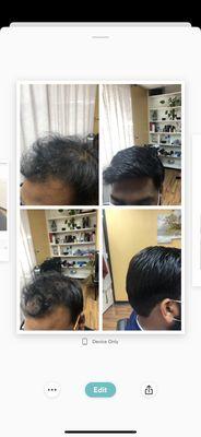 Hair replacement before and after