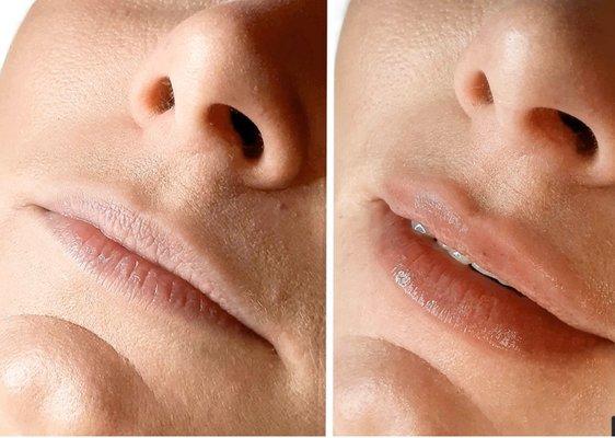 Hyaluronic Acid Needle Free Lip Fillers