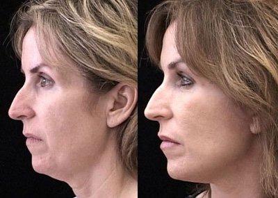 Neck lift and fat grafting