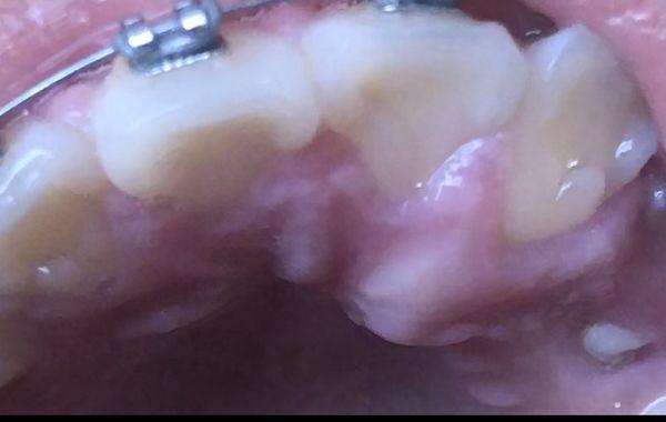 Bump on roof of mouth caused by them but never fixed.