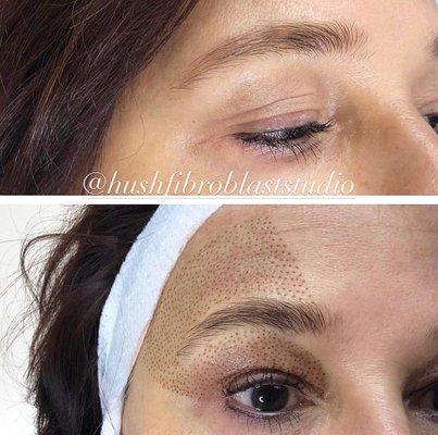 Before and Immediately after Eyelid and Brow lift.