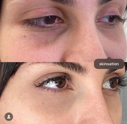 Under eye PRP and laser