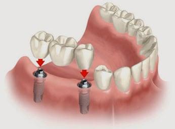 Dental Implants & Crowns - Experience Dental Excellence! Serving Corona, CA