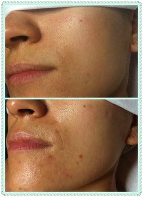 Diminished pores & uplifting after treatment