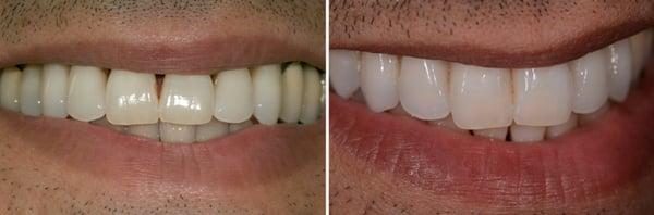 Gum Disease Treatment