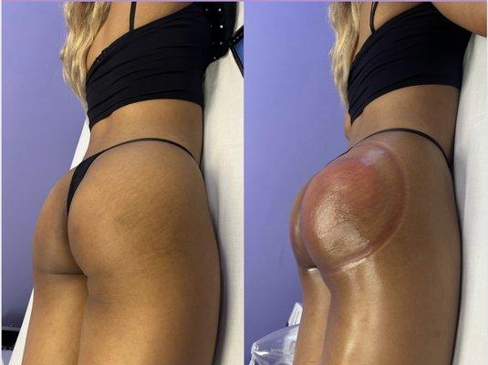 BBL Buttcuping before and after the treatment