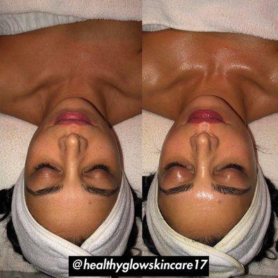 HealthyGlow customized signature facial