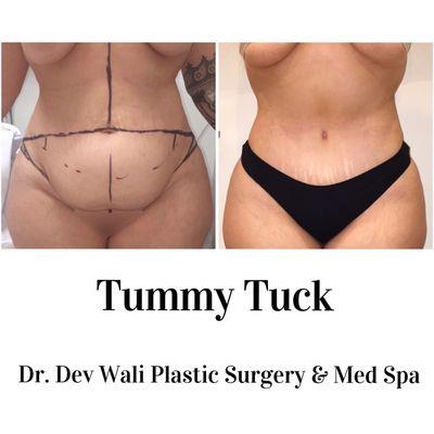 Tummy Tuck by Dr. Wali