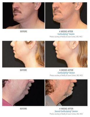 Coolsculpt Mini for unwanted neck fat! Freeze that fat away!