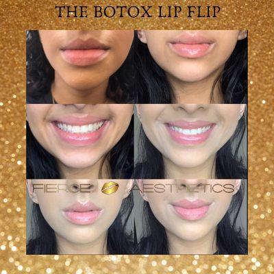 Botox Lip Flip