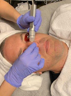 Microdermabrasion, male client.