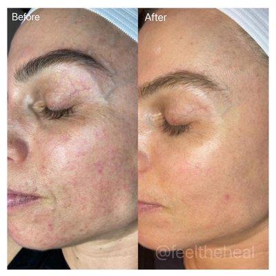 Microneedling with Prp