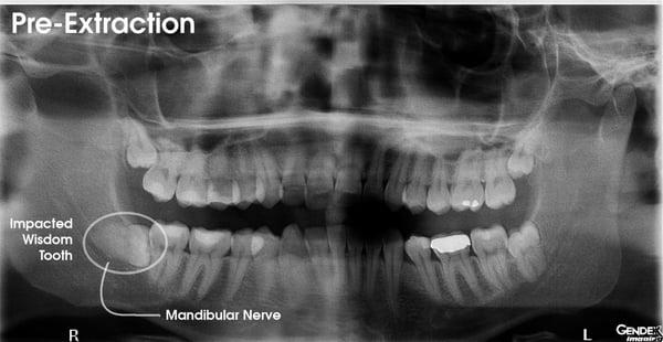 Panoramic x-ray prior to wisdom teeth extraction. Notice how the impacted wisdom tooth is so close to the nerve canal.