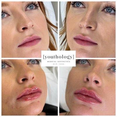 Beautiful Lip filler