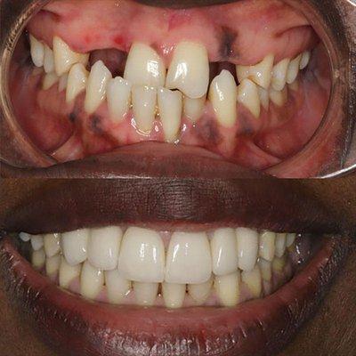 Dental Implants Midtown Manhattan | Before After