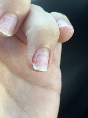 Ripped nail