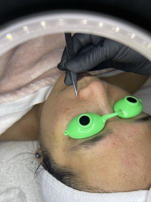 Facial treatment with extractions.