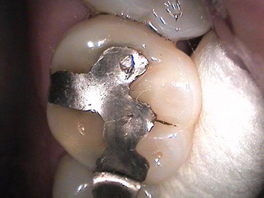 BEFORE: old filling in amalgam