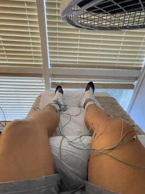 Right knee acupuncture.