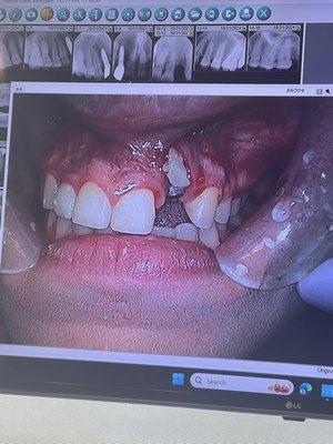 The ramus grafting and implant damage caused by Dr. Vaiana